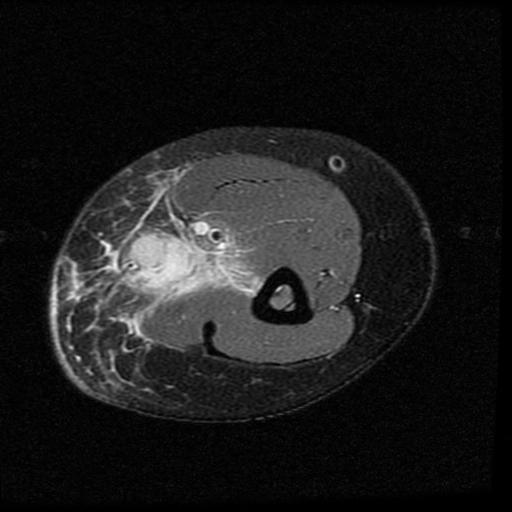 Figure 2 for case cat scratch disease